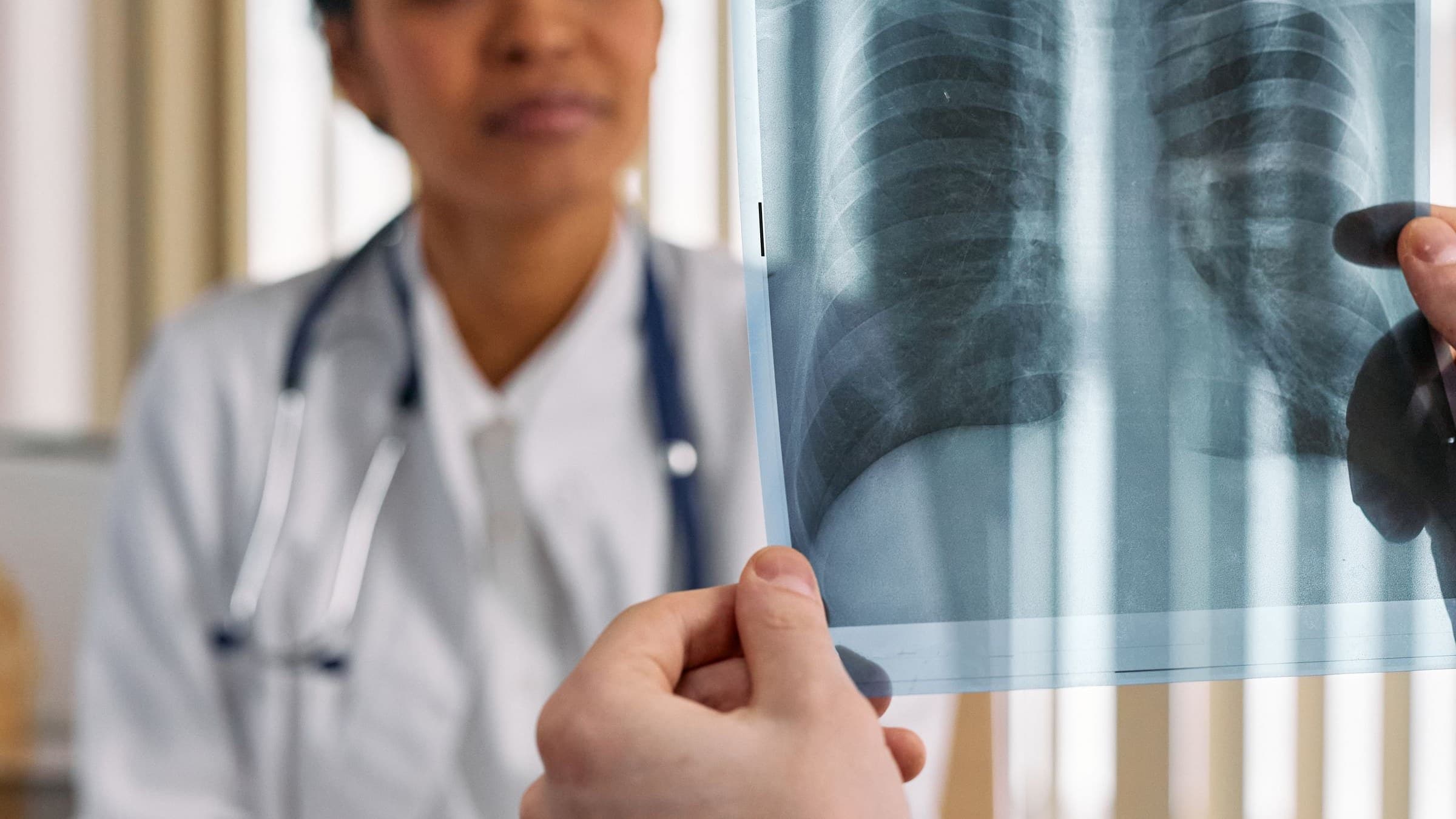 Hand holding a chest X-ray film in front of a doctor in a white coat with a stethoscope